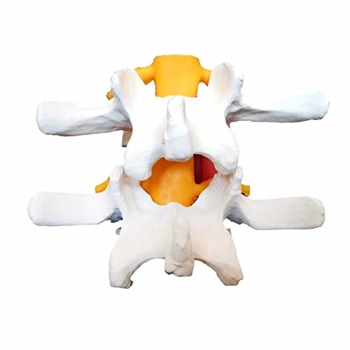 mike-dental Hernia Hernia de Disco Lumbar lumbar modelo anatómico, humano médica anatomía